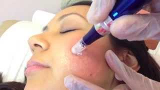 Micro Needling SkinPen for acne scarring [upl. by Acysej]