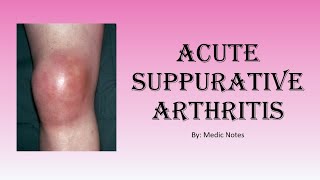 Ortho Acute suppurative arthritisseptic arthritis  clinical feature investigation treatment [upl. by Westland992]