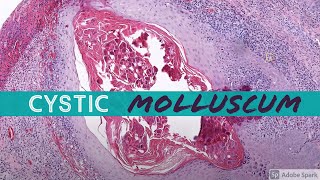 Molluscum Contagiosum cystic 5Minute Pathology Pearls [upl. by Kati]