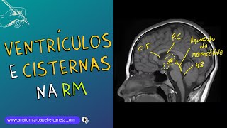 Ventrículos e Cisternas Cerebrais por RM [upl. by Ahsatel]