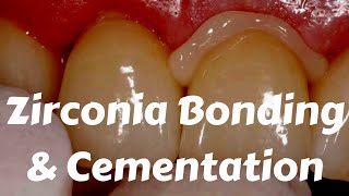 Zirconia Crown Cementation Bonding Protocols by Etching sandblasting amp Ivoclar Multilink [upl. by Starr]