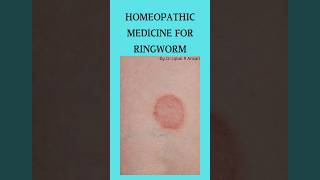 Homeopathic medicine for ringworm driqbalansari homeopathy shorts [upl. by Ancilin]