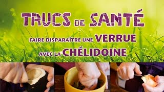 Trucs de santé 6  faire disparaitre une verrue avec la chélidoine  Sophie Lacoste [upl. by Yorztif399]