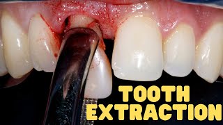 Tooth Extraction Explained  Wisdom Teeth Extraction Aftercare [upl. by Aihseuqal708]