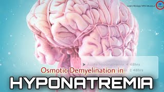 Osmotic Demyelination in HYPONATREMIA  3D animated videos  brain dysfunction [upl. by Kcirdderf]