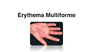 Erythema Multiforme  Causes Complications amp Treatment [upl. by Wadesworth]