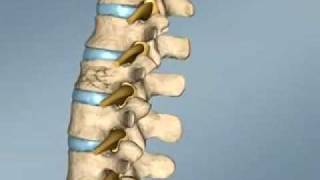 Spine Surgery Croatia  Vertebroplasty [upl. by Ateinotna]