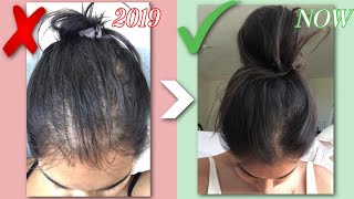 HOW I GREW MY HAIR BACK NATURALLY  QampA BEFORE amp AFTERS HAIR LOSS STORY  RESULTS IN JUST 1 MONTH [upl. by Einal]