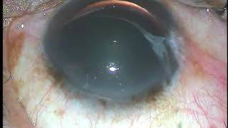 Intravitreal injection of Bevacizumab or Ranibizumab  Pradip Mohanta [upl. by Miharba39]