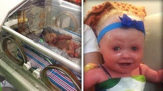 New York Babys Skin Cracked Minutes After Her Birth Due to Rare Condition [upl. by Alta]