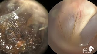 157  Severe Ear Wax Extraction From Difficult Twisty Ear using the WAXscope®️ [upl. by Ruel]