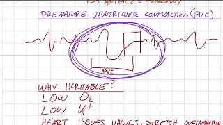 EKG 311  More on PVCs [upl. by Ahsemak]