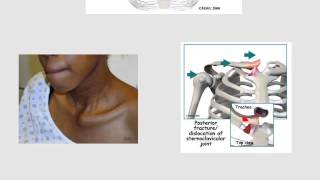 sternoclavicular joint dislocation [upl. by Landry]