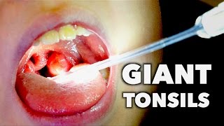 GIANT TONSILS  Strep Throat  Dr Paul [upl. by Enawyd]