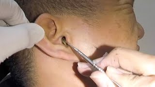 One Hard Earwax Removed form Mans Ear [upl. by Nayab]