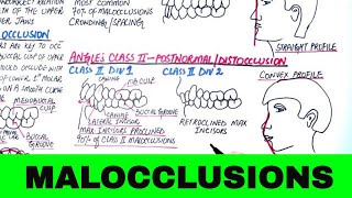 Angles Classification of Malocclusion  Orthodontics [upl. by Payne]