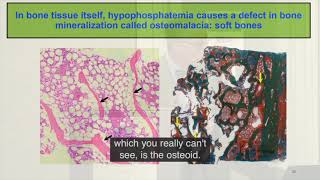 The Symposium on Hypophosphatemia Clinical Overview [upl. by Ahsikin272]