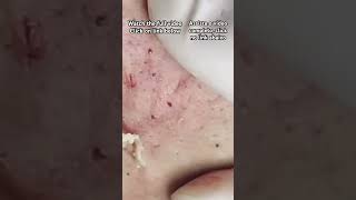 Big Cystic Acne Blackheads ExtractionBlackheads amp Milia Whiteheads Removal Pimple Popping [upl. by Ermentrude830]