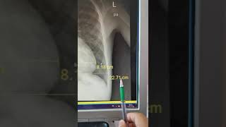 cardiothoracic ratio النسبة القلبية الصدرية [upl. by Ahseinad119]