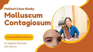 A Case Study of Molluscum Contagiosum [upl. by Jezabella]