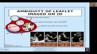 تقييم صمامات الجهة اليمنى من القلب بالإيكو Echocardiographic Evaluations of The Right Sided Valves [upl. by Florentia537]