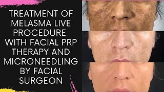 Treatment of Melasma Live Procedure with Facial PRP Therapy and Microneedling by Facial Surgeon1 [upl. by Blakely]