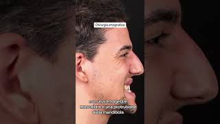 how to sole the protrusive mandible doublejawsurgery chin surgery orthognathicsurgery italy [upl. by Darnok]