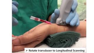 ULTRASOUND GUIDED RADIAL ARTERY PT CHUI [upl. by Ireva67]