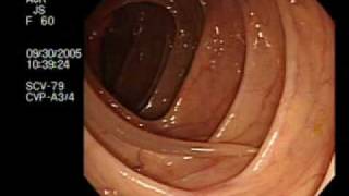 Colonoscopy Demonstrating a Moving Worm  NEJM [upl. by Ydahs]