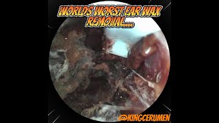 Most Disgusting Ear Wax Removal [upl. by Ahsakat]