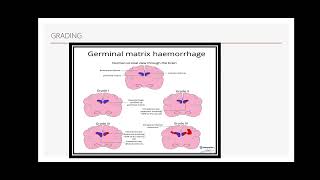 Intraventricular haemorrhage ivh germinal matrix hemorrhage Periventricular leucomalcia [upl. by Rahsab]