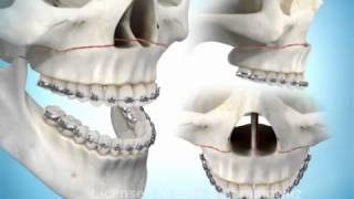 Osteotomia di avanzamento del mascellare superiore [upl. by Oikim807]