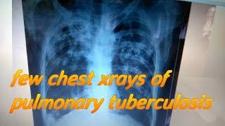 chest xray PA view of pulmonary tuberculosis [upl. by Phineas]