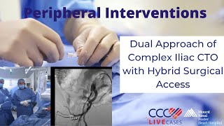 Dual Approach of Complex Iliac CTO with Hybrid Surgical Access [upl. by Elletsyrc224]