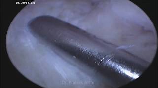 MUCOID DEGENERATION OF ACL  ARTHROSCOPIC TREATMENT [upl. by Eleumas]