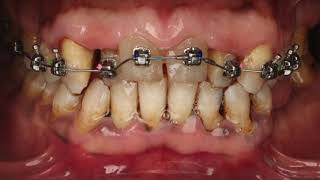 Preprosthetic orthodontic treatment full mouth Rehabilitation [upl. by Aiouqes]