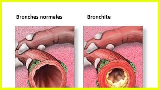 Traitement naturel de la bronchite [upl. by Jedidiah]