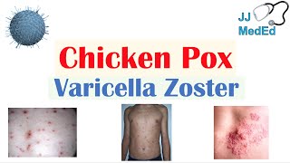 Chickenpox  Varicella Zoster Virus  Pathogenesis Signs and Symptoms Diagnosis and Treatment [upl. by Dempstor]