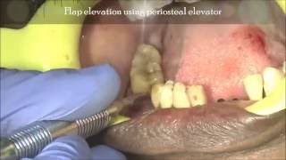 LuxationExtraction of second molarperiodontitis with cowhorn forceps [upl. by Hentrich269]