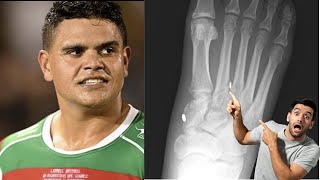 Latrell Mitchell LISFRANC FOOT INJURY Explained Will he need SURGERY [upl. by Felicia]