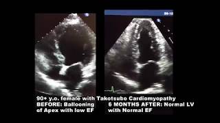 2d Echocardiogram takotsubo Cardiomyopathy [upl. by Aivil]