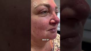 Pulsed Dye Laser Treatment for Rosacea amp Facial Redness  Dr Sheher Bano Khan  Ipal Clinic [upl. by Garcon]