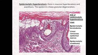 Lecture57 Inherited disorders of cornification Part 3 Nonsyndromic keratodermas Rooks ch 65 [upl. by Dorahs970]