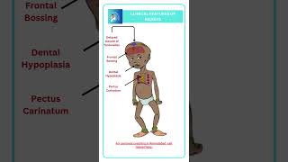 Clinical features of Rickets [upl. by Lefty]