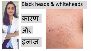 blackheads whiteheads treatment  ब्लाक हेड्ज़ को कैसे निकाले  त्वचा के डॉक्टर [upl. by Nivets]