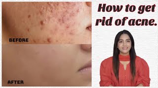 How to get rid of acne  Fungal acne  Bacterial acne  causes and solutions  Asma khan [upl. by Noslien261]