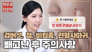 ⚠검버섯 점 비립종 편평사마귀 제거 전 후 필수 시청 영상⚠ㅣ노남경의 피부클래스 [upl. by Lrac]