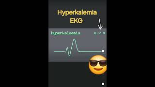 Hyperkalemia EKG [upl. by Aenat593]