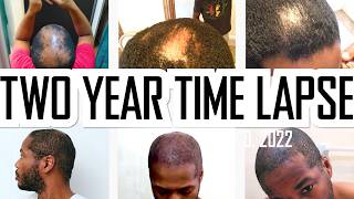 Hair Regrowth  2 Years of Microneedling [upl. by Yrtneg]