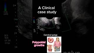 clinical case study of cervical polyps health ultrsound doctortips shortsbeta DrSaima Khan [upl. by Llenrap]